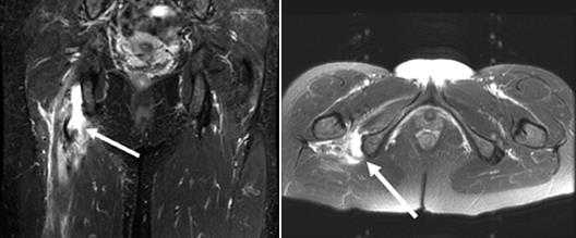 Болевой синдром внесуставной локализации (хамстринг-синдром, АРС-синдром)