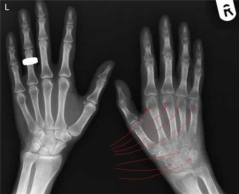 Синдром Зудека острая стадия I 4-5 неделя.jpg