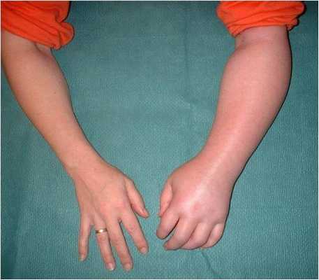 Синдром Зудека осмотр визуальная картина левой кисти стадия 1-2.jpg