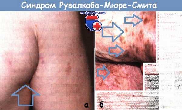 Синдром Рувалкаба-Мюре-Смита