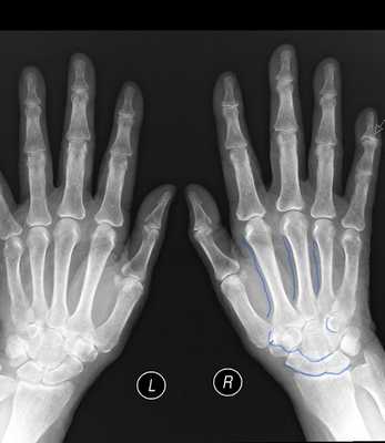 Зудек стади 2 дистрофия очерчение карандашом.jpg