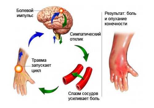 Порочный круг при синдроме Зудока.jpg