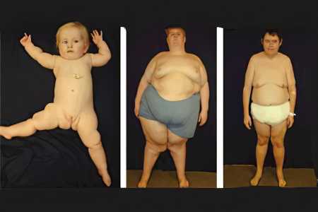 Симптомы синдрома Прадера-Вилли