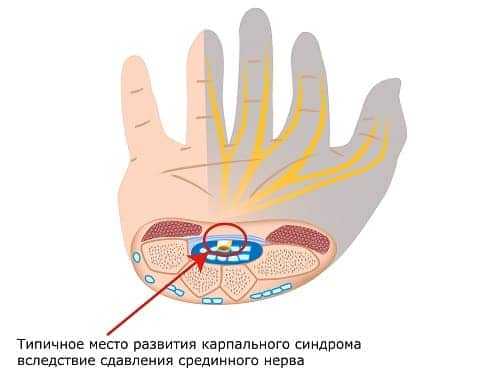Место сдавления срединного нерва и области его иннервации