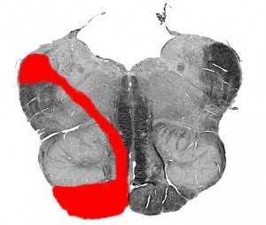 Синдром Сестана-Шене (срез)