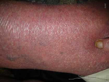 Синдром Сезари (СС)