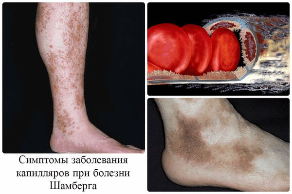 Основные признаки болезни Шамберга