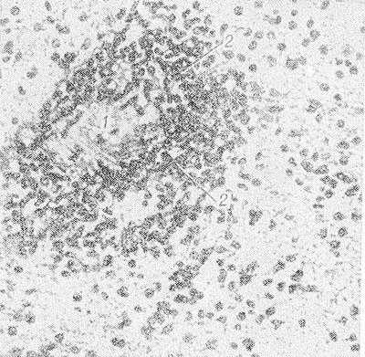 Рис. 2. Микропрепарат ткани белого вещества мозга больного, умершего от геморрагического лейкоэнцефалита: стенка кровеносного сосуда (1) инфильтрирована и окружающая нервная ткань пропитана полиморфно-ядерными лейкоцитами (2).