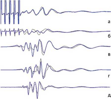 Болезнь Шпренгеля