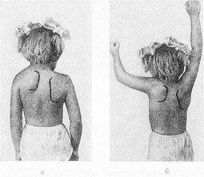 Рис. Девочка 5 лет с болезнью Шпренгеля (контуры обеих лопаток обведены сплошными линиями): а — левая лопатка расположена выше правой, уменьшена в размерах, смещена к позвоночнику, на стороне поражения надплечье расположено выше, чем на здоровой стороне; б — та же девочка с поднятыми руками (резко ограничена функция левого плечевого сустава).