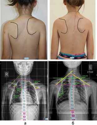 Болезнь Шпренгеля
