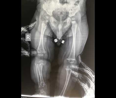 Метафизарная дисплазия вид