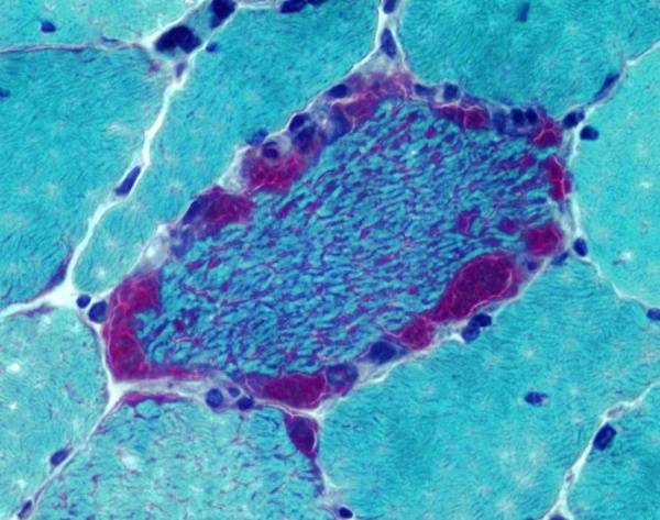 Синдром Рассела-Сильвера