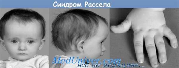 синдром Рассела