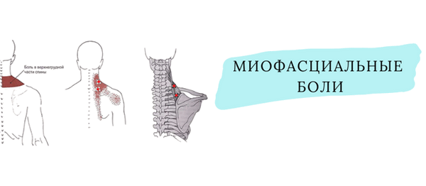 Миофасциальные боли