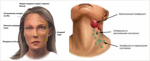Воспаление нервного узла