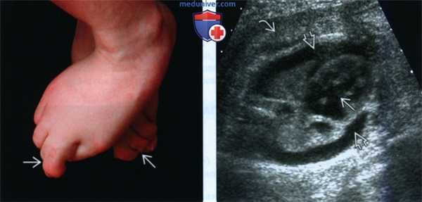 УЗИ при синдроме Смита-Лемли-Опица (ССЛО) у плода