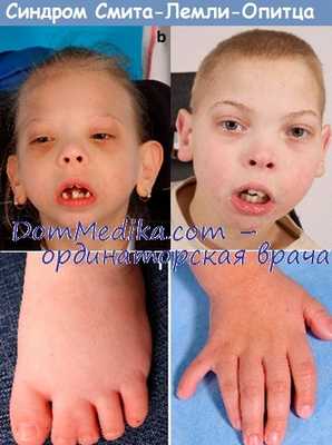 Синдром Смита-Лемли-Опитца