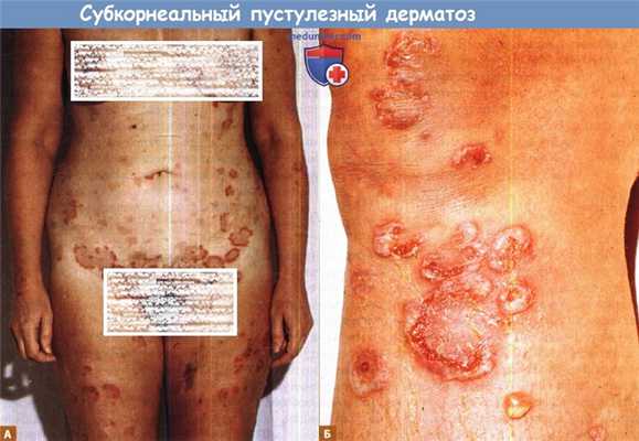 Субкорнеальный пустулезный дерматоз (болезнь Снеддона-Уилкинсона)