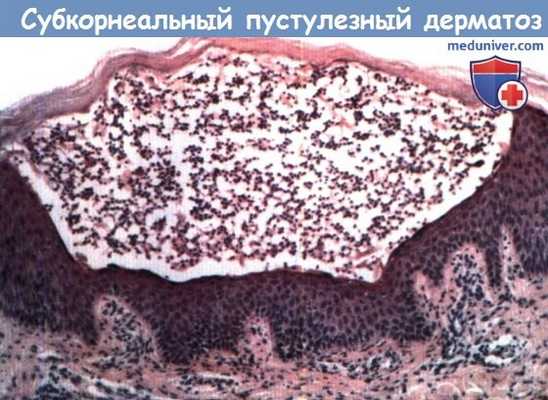 Субкорнеальный пустулезный дерматоз (болезнь Снеддона-Уилкинсона)