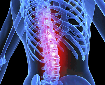 Фото Болезнь Бехтерева