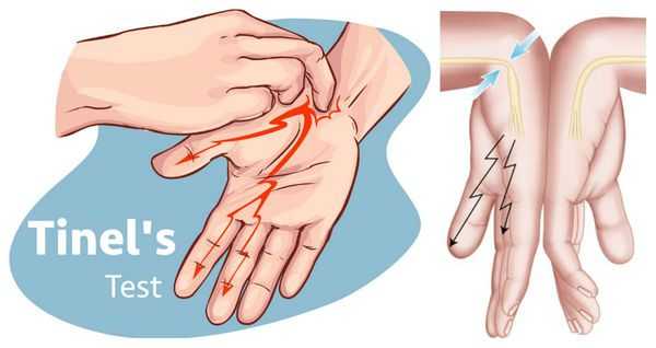 Тест Тинеля и Фалена