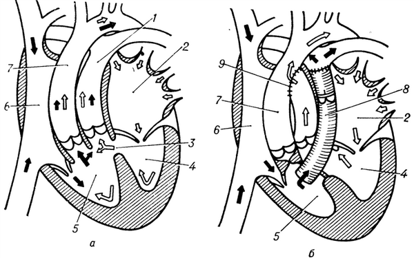 Схематическое изображение сердца и магистральных сосудов на фронтальном разрезе при синдроме Тауссиг— Бинга до (а) и после (б) радикальной коррекции порока (по методу Смита): 1 — легочный ствол; 2 — левое предсердие; 3 — дефект межжелудочковой перегородки; 4 — левый желудочек; 5 — правый желудочек; 6 — правое предсердие; 7 — аорта; 8 — клапансодержащий протез легочного ствола; 9 - анастомоз резецированного отрезка легочного ствола и аорты конец в бок; направление движения венозной крови показано темными стрелками, артериальной крови — светлыми стрелками.