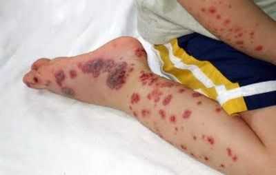 Болезнь Мошковица