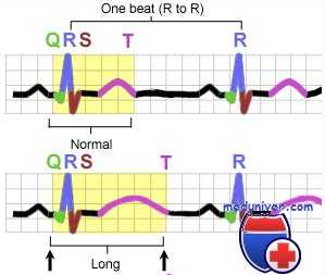 синдром удлиненного QT