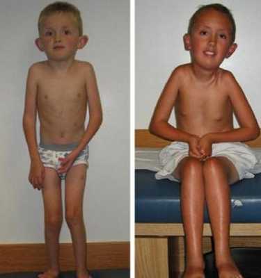 врожденные мышечные дистрофии