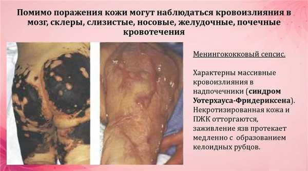 менингококковая симптоматика