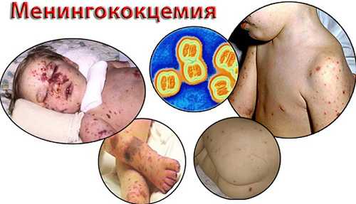 менингококцемия