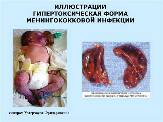 гнойные менингиты у детей