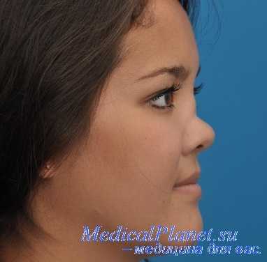 гранулематоз вегенера