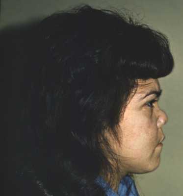 Рис. 1. Седловидная деформация носа