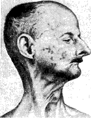 Вернера синдром (больному 26 лет). Черты лица заострены; выявляется так называемый птичий нос; выступает подбородок, ротовое отверстие сужено.