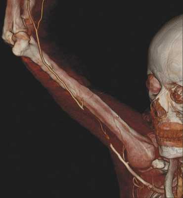 Закупорка плечевой артерии