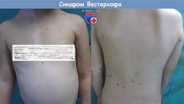 Синдром Вестерхофа