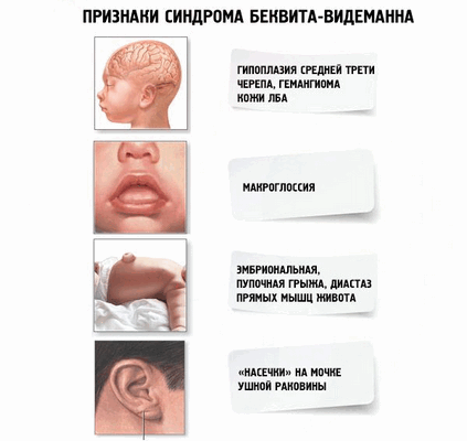 Признаки синдрома Беквита-Видемана