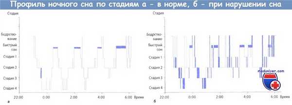 Профиль ночного сна по стадиям