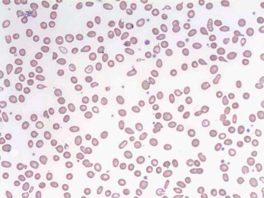 Лечение синдрома Юргенса в Израиле