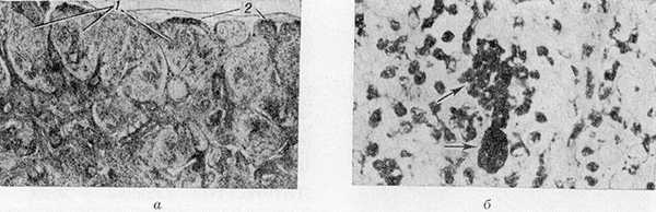 Микропрепараты лимфатического узла больного липомеланотическим ретикулезом: а — обширная ретикулярная гиперплазия (1) и сохранившаяся капсула (2), X 13; б — отложения меланина внутри и внеклеточно (указано стрелками), х 750.