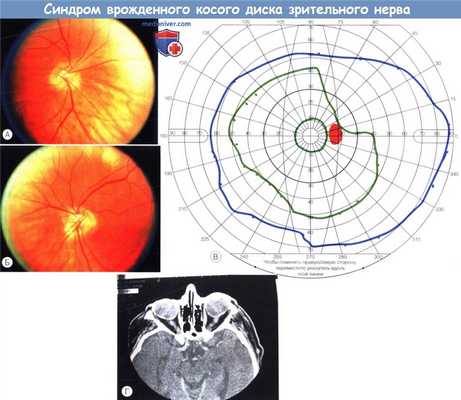 Синдром врожденного косого диска зрительного нерва