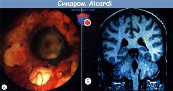 Синдром Aicardi