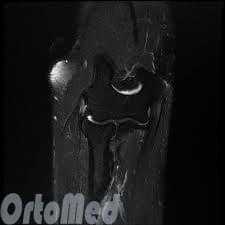 болезнь Де Кервена