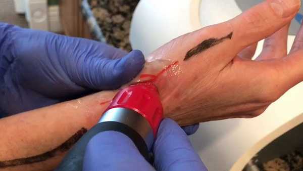 Лечение болезни де Кервена ударно-волновой терапии