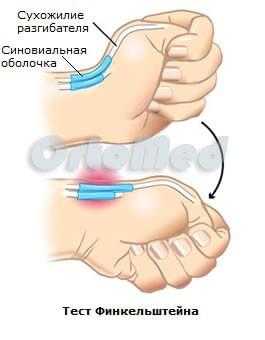 Диагностика болезни де кервена