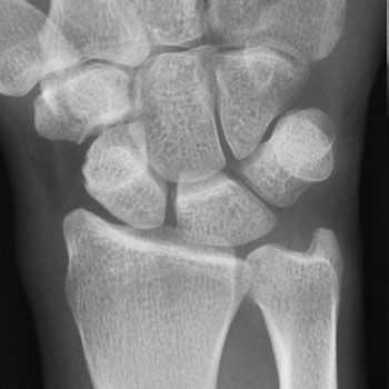 болезнь де кервена диагностика