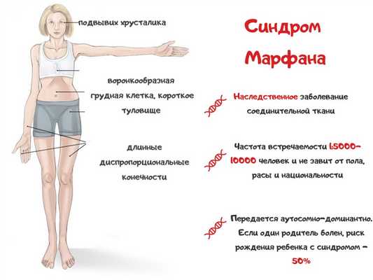 Синдром Марфана.jpg