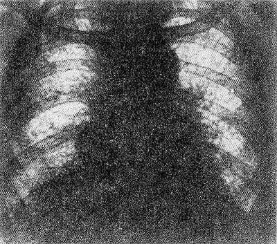 Рис. Рентгенограмма грудной клетки больного с синдромом Хаммена — Рича (прямая проекция): резкое усиление и тяжисто-ячеистая деформация легочного рисунка.